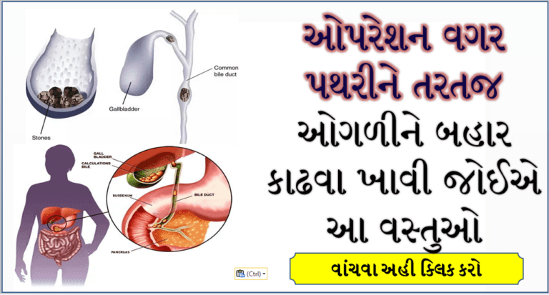 ઓપરેશન વગર પથરીને તરત જ ઓગળીને બહાર કાઢવા ખાવી જોઈએ