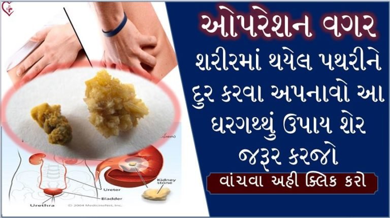 ઓપરેશન વગર શરીરમાં થયેલ પથરીને દુર કરવા અપનાવો આ ઘરગથ્થુ ઉપાય વાંચો અને શેર કરો