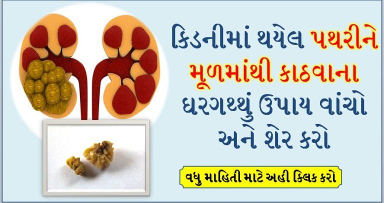 કિડનીમાં થયેલ પથરીને મૂળમાંથી કાઠવાના ઘરગથ્થું ઉપાય વાંચો અને શેર કરો