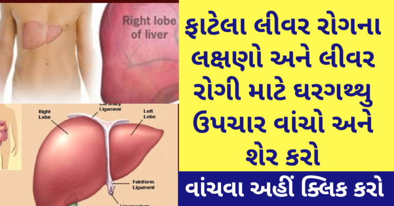 ફાટેલા લીવર રોગના લક્ષણો અને લીવર રોગી માટે ઘરગથ્થુ ઉપચાર વાંચો અને શેર કરો