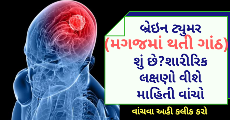 બ્રેઇન ટ્યુમર (મગજમાં થતી ગાંઠ) શું છે?શારીરિક લક્ષણો વીશે માહિતી વાંચો