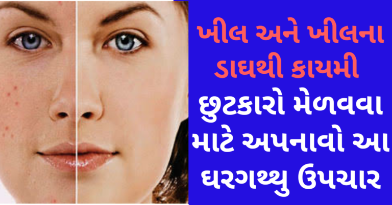 ખીલ અને ખીલના ડાઘથી કાયમી છુટકારો મેળવવા માટે અપનાવો આ ઘરગથ્થુ ઉપચાર