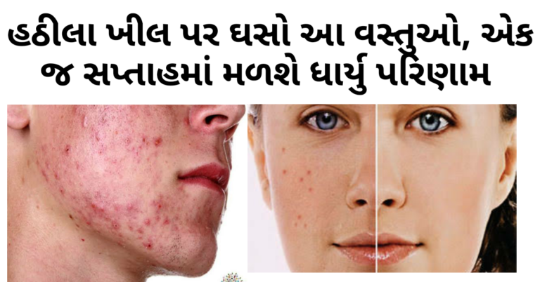 હઠીલા ખીલ પર ઘસો આ વસ્તુઓ, એક જ સપ્તાહમાં મળશે ધાર્યુ પરિણામ વાંચો અને શેર કરો