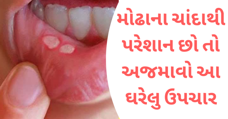 મોઢાના ચાંદાથી પરેશાન છો તો અજમાવો આ ઘરેલુ ઉપચાર
