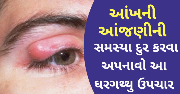 આંખની આંજણીની સમસ્યા દુર કરવા અપનાવો આ ઘરગથ્થુ ઉપચાર