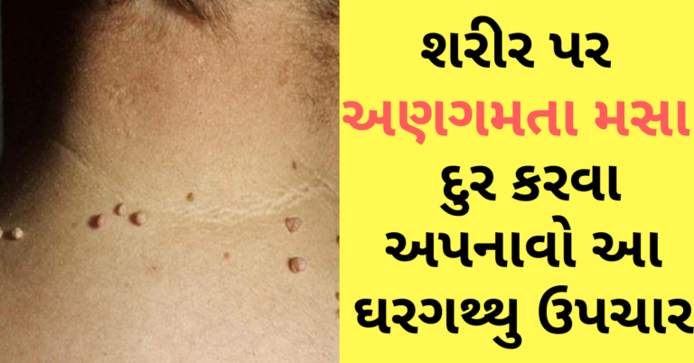 શરીર પર અણગમતા મસા દુર કરવા અપનાવો આ ઘરગથ્થુ ઉપચાર