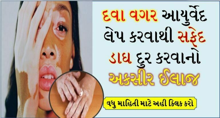દવા વગર આયુર્વેદ લેપ કરવાથી સફેદ ડાઘ દુર કરવાનો અકસીર ઈલાજ