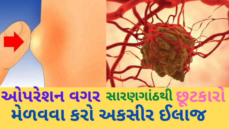 ઓપરેશન વગર સારણગાંઠથી છૂટકારો મેળવવા કરો અકસીર ઈલાજ