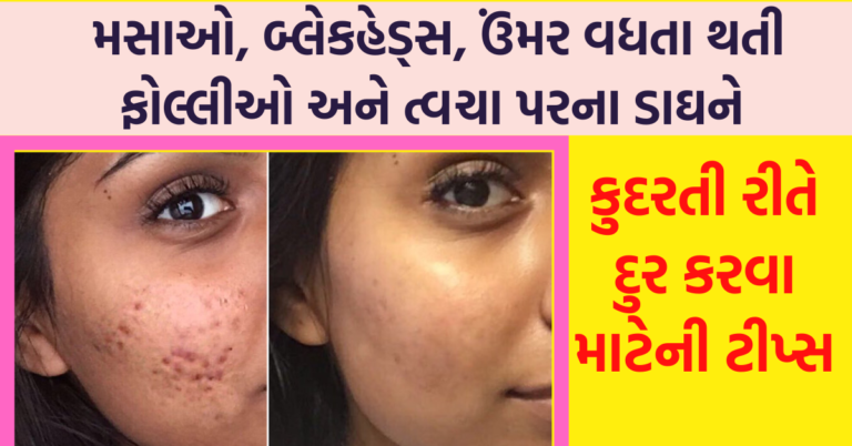 મસાઓ, બ્લેકહેડ્સ, ઉંમર વધતા થતી ફોલ્લીઓ અને ત્વચા પરના ડાઘને કુદરતી દુર કરવા માટેની ટીપ્સ